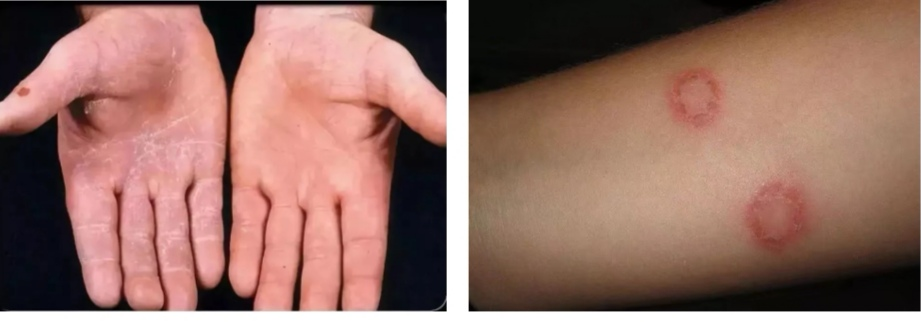 猫癣.png